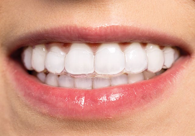 clear-aligners clear-aligners