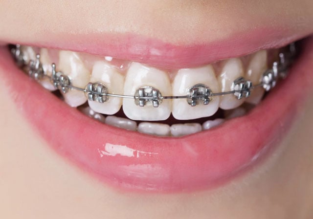 fixed metal braces fixed metal braces