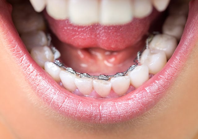 lingual braces lingual braces